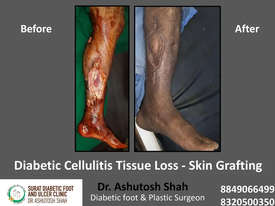 Diabetic Cellulitis and Coverage.pptx-5.webp